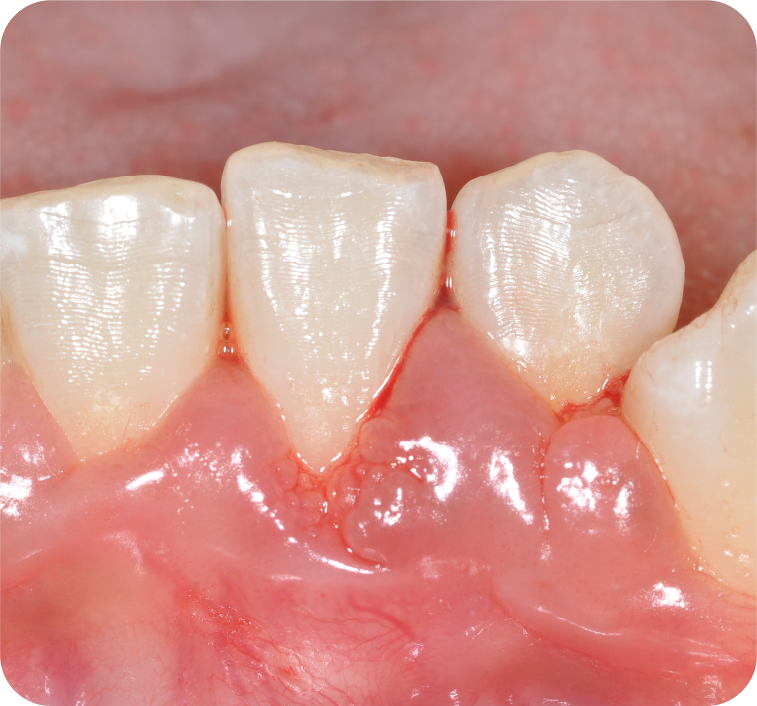 Do your gums bleed?
