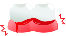 Bleeding Gums