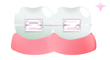 Cleaning Braces, Back Teeth, & Other Tight Spaces